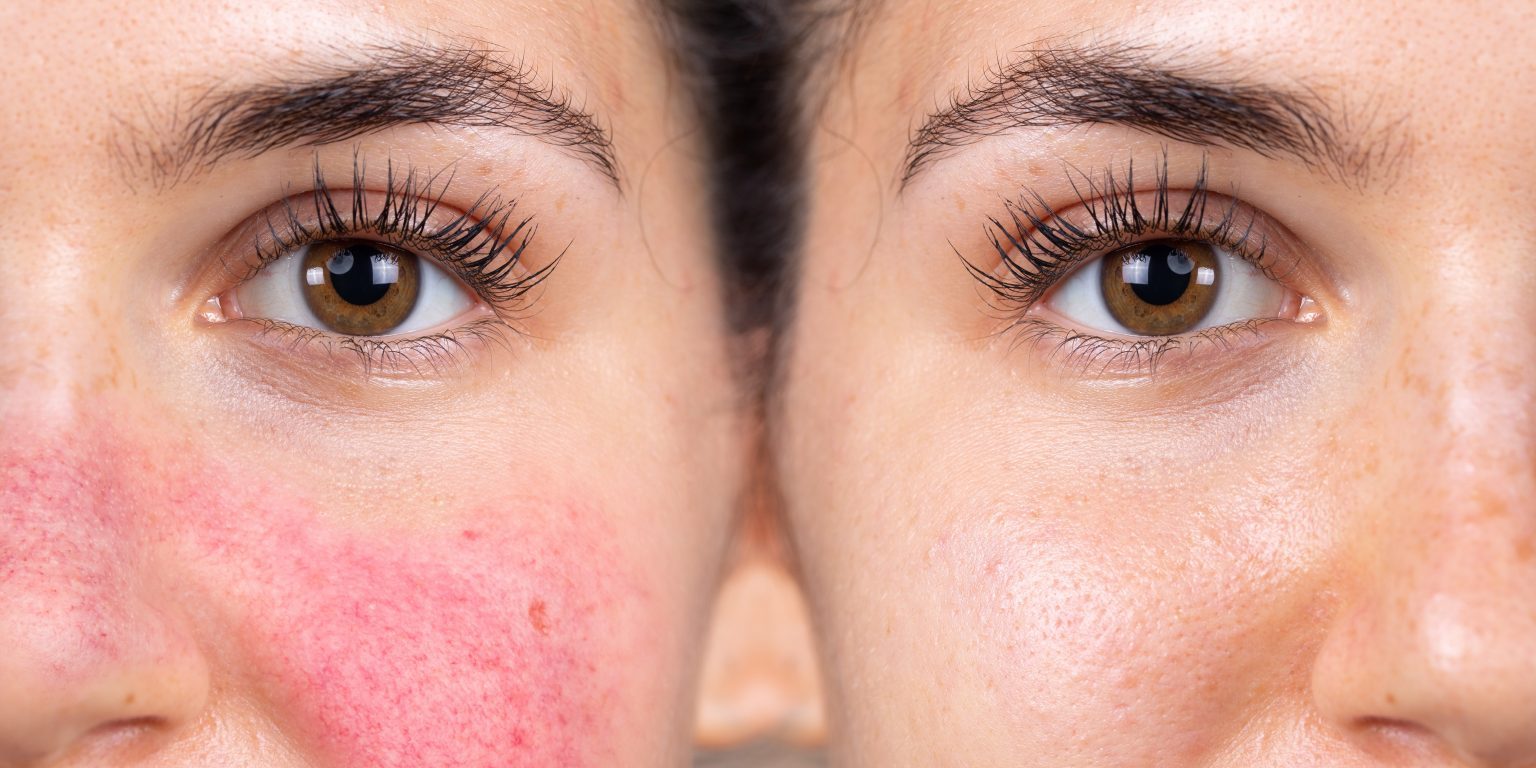 Rosacea Causes Triggers And What You Can Do About It 7173